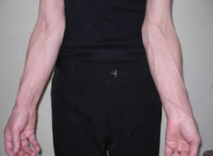 à quoi ressemblent les varices sur les mains